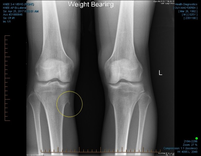 KNEE 3-4 VIEWS (RIGHT) 0002